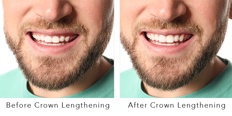 Before & After Crown Lengthening example