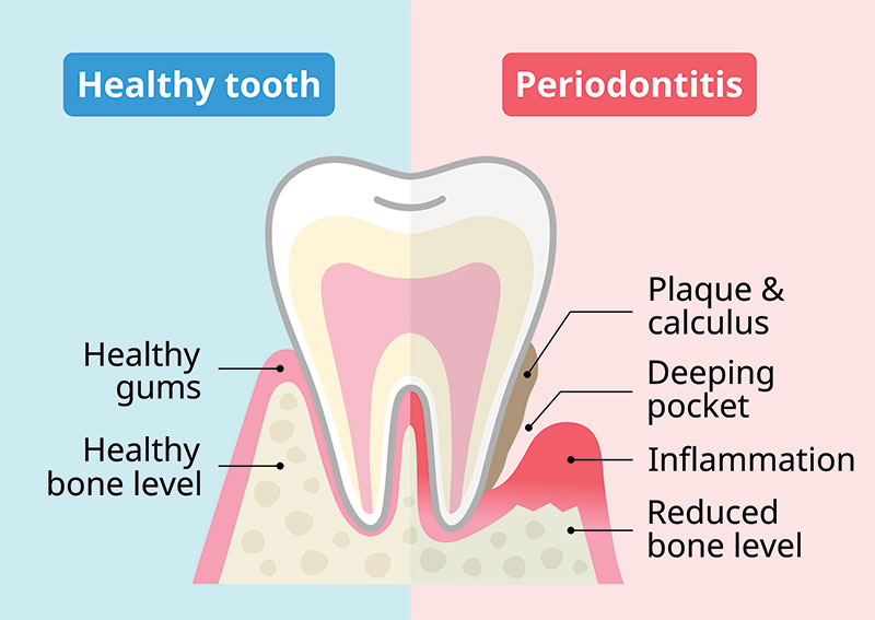 periodontal disease example