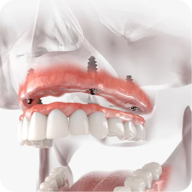 Dental Implants