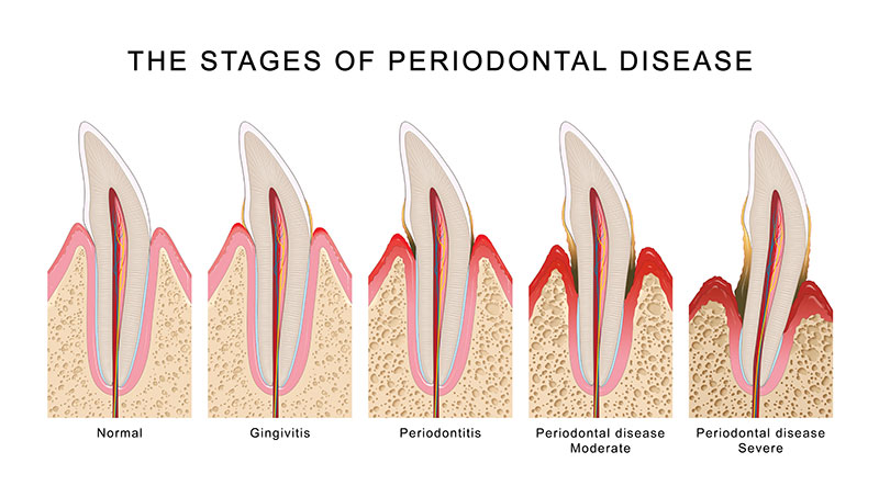 stages of periodontal disease graphic